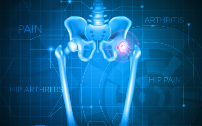 Understanding Arthritis of the Hip and How To Treat It