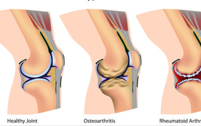 3 Treatment Options for Knee Arthritis
