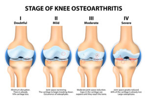 knee-arthritis-stages