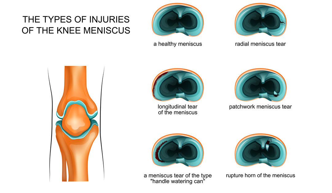 meniscus tears