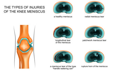 The Different Types of Meniscus Tears (And How They’re Treated)