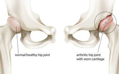 4 Hip Osteoarthritis Treatment Options