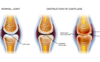 Knee Cartilage and How It Protects the Knee