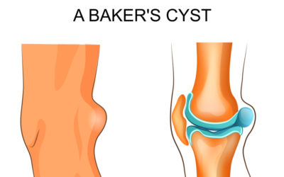 What Causes a Baker’s Cyst and How’s It Treated?