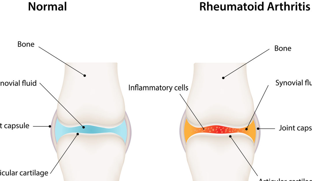 rheumatioid arthritis