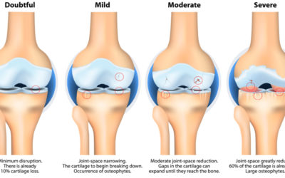 Everything You Need to Know About How Knee Arthritis is Classified and Treated