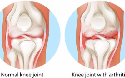 Nonsurgical Treatment of Osteoarthritis Related Knee Pain
