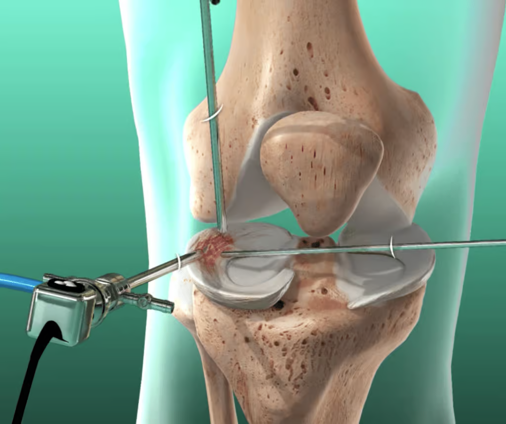 Meniscus Surgery